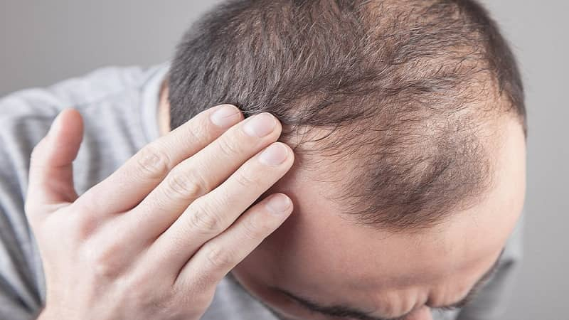 hair transplant trypophobia