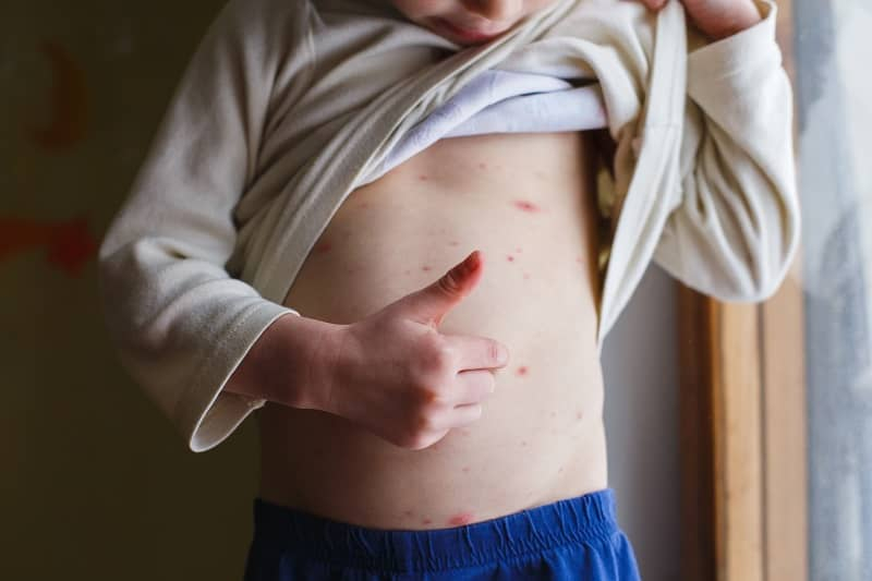 Symptoms of Chickenpox