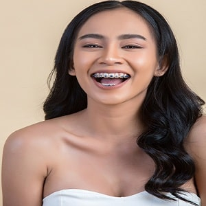 Essential Tips for Invisible Braces Wearers